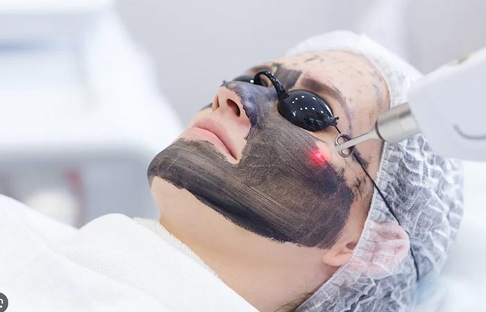 q-switch laser therapy